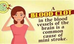Symptoms of a Mini Stroke